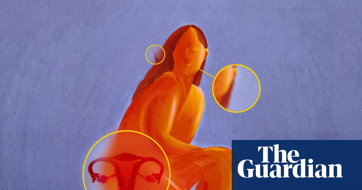 What is PCOS, what are the symptoms and treatment, and why is it being renamed PMOS?