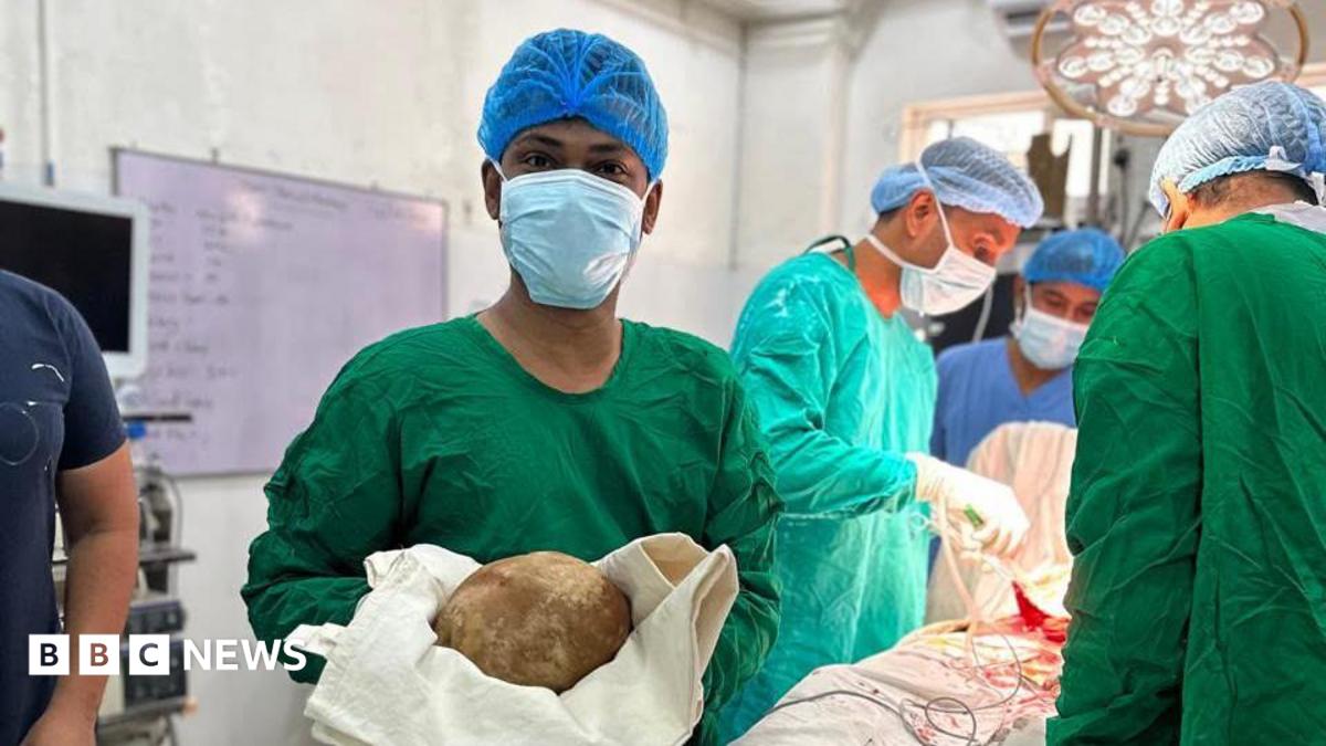 Doctors remove 3.1kg stone from man's bladder and claim record