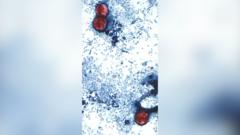 US reports first two deaths linked to parasitic infection outbreak